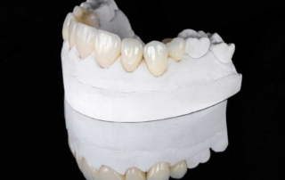 What You Need to Know About Inlays, Onlays, and Veneers?