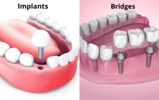 Implants and Bridges: What Dentist's Can Do for You